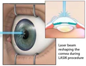 15 Amazing Facts About the Importance and Medical Uses of Laser Beams Eye surgery with lasers