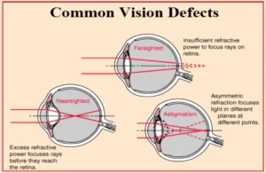 The uses of lenses to treat the vision defects Eye defects