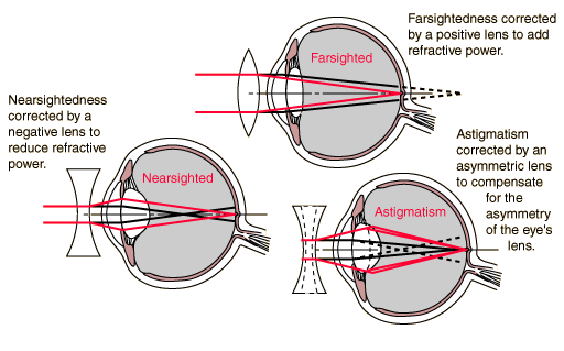 The uses of lenses to treat the vision defects | Science ... myopia hyperopia diagrams 