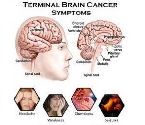 Brain cancer symptoms