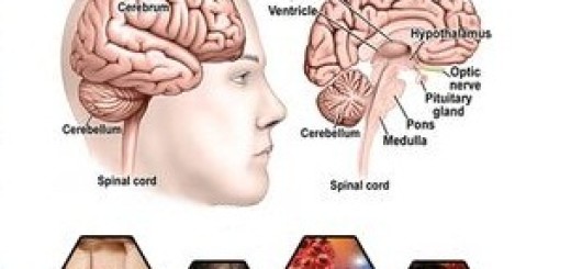 Brain cancer symptoms