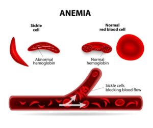 Abnormal types of hemoglobin 