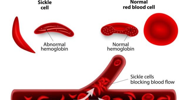 Abnormal types of hemoglobin