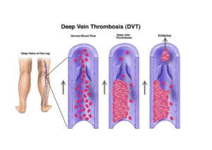 Thromboembolic disorders