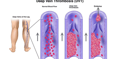 Thromboembolic disorders