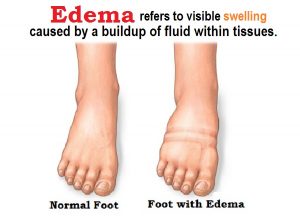 Edema symptoms 
