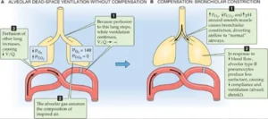 Regional difference in ventilation, Pulmonary circulation, Shunt and Lung perfusion zones Regional difference in ventilation