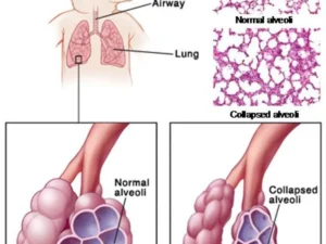 Normal and abnormal lung compliance, Elastance, Surfactant and work of breathing Lung compliance