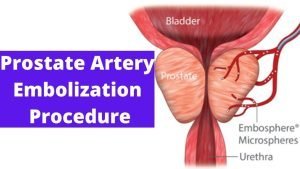 Prostatic artery embolization