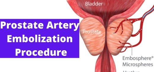 Prostatic artery embolization