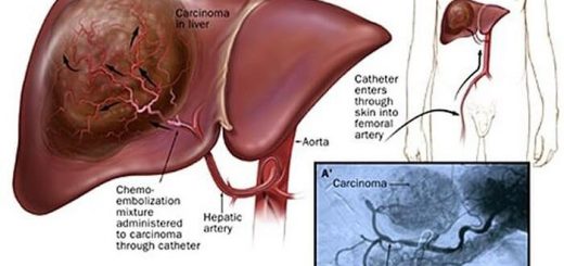 Embolization therapy for Liver cancer