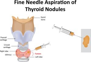 Thyroid Fine Needle Aspiration Biopsy