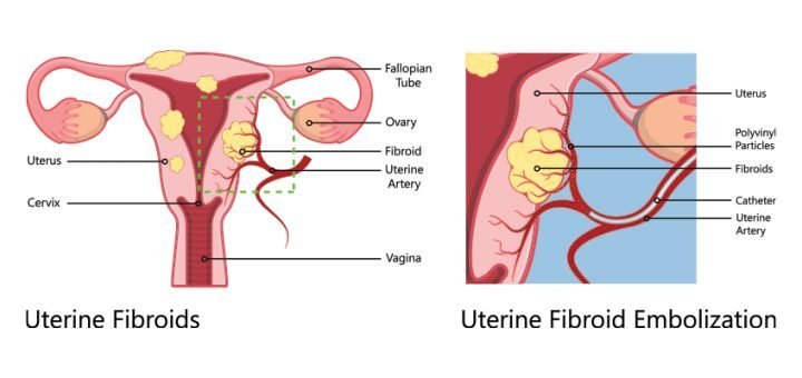 Uterine fibroid embolization