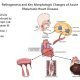 pathogenesis of rheumatic fever