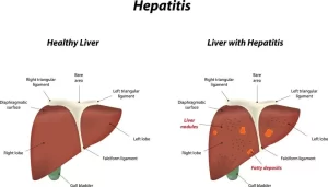 Liver Hepatitis