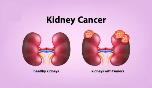 Tumors of the kidney 