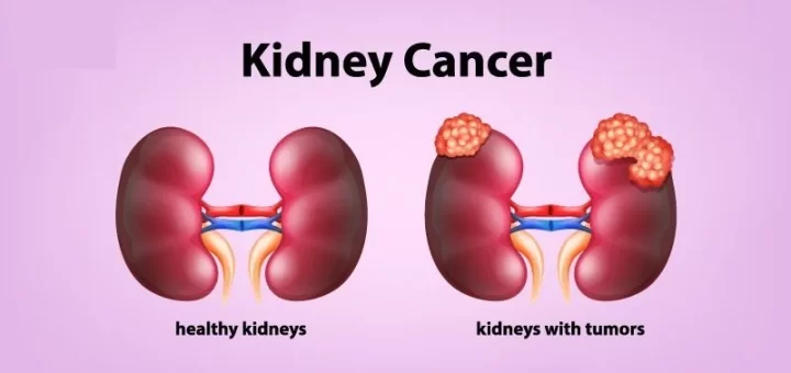 Tumors of the kidney