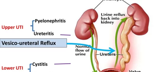 Upper UTI and Lower UTI