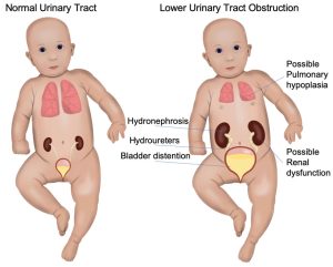 Urinary tract obstruction 