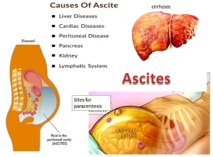 Ascites causes