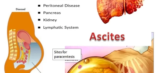Ascites causes