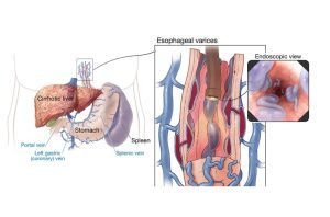Gastro-esophageal varices 