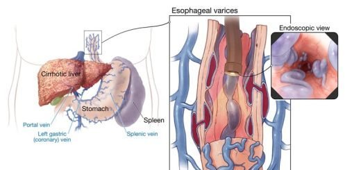 Gastro-esophageal varices