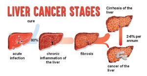 Hepatic Tumors stages