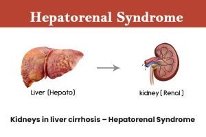 Hepatorenal syndrome
