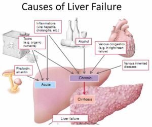 Liver failure cause