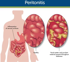 Spontaneous bacterial peritonitis