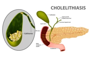 Acute and chronic Cholecystitis
