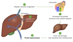 Budd-chiari syndrome