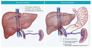 Budd-chiari syndrome vs Portal vein thrombosis