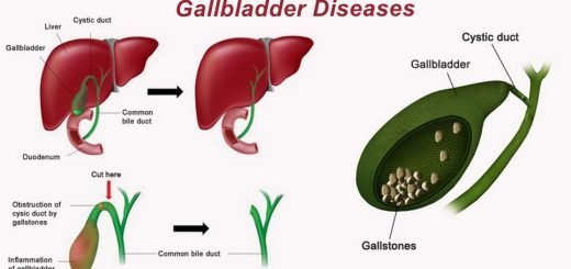 Gallbladder diseases