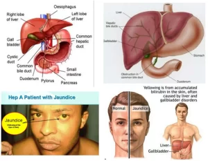 Jaundice symptoms and causes