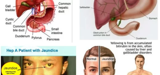 Jaundice symptoms and causes