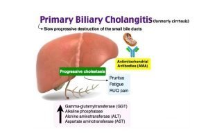 Primary biliary cirrhosis 