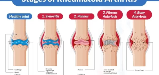 Rheumatoid Arthritis