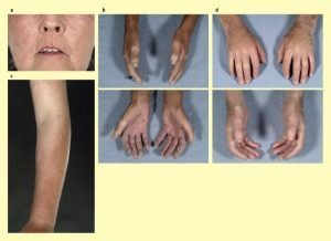 Systemic Sclerosis types