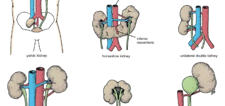 Anomalies of the kidney