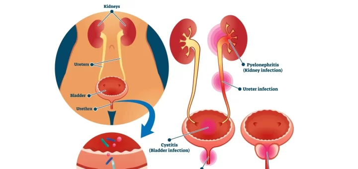 Urinary tract infections