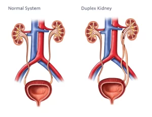Anomalies of renal pelvis and ureter