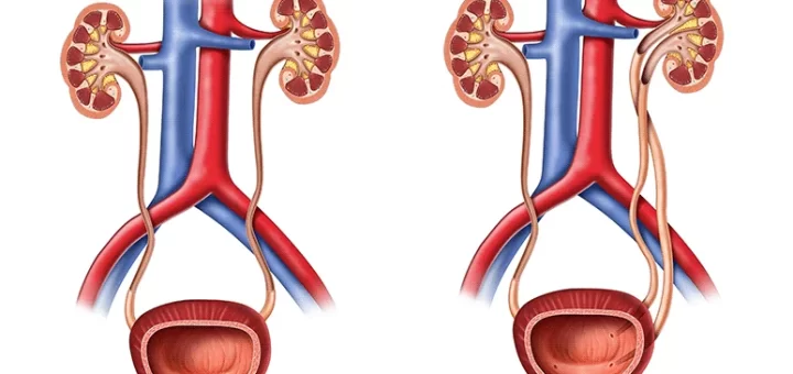 Anomalies of renal pelvis and ureter