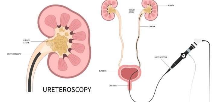 Stones in the kidney