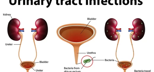 Urinary tract infection