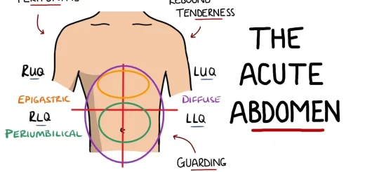Acute Abdomen