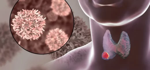 Follicular thyroid carcinoma