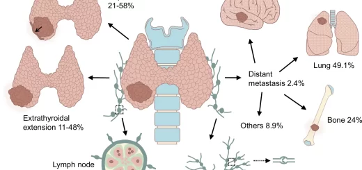 Papillary thyroid carcinoma