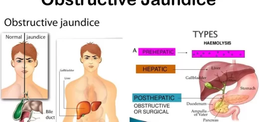 Surgical Jaundice